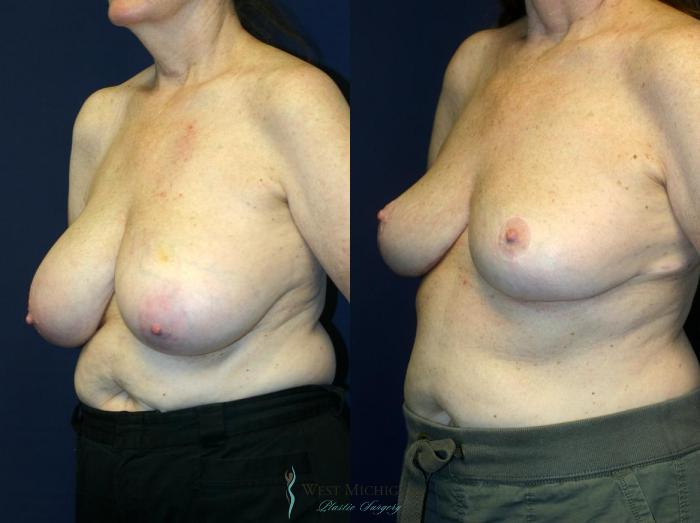Before & After Breast Reduction Case 9118 View #3 View in Portage, Kalamazoo, Battle Creek, Michigan
