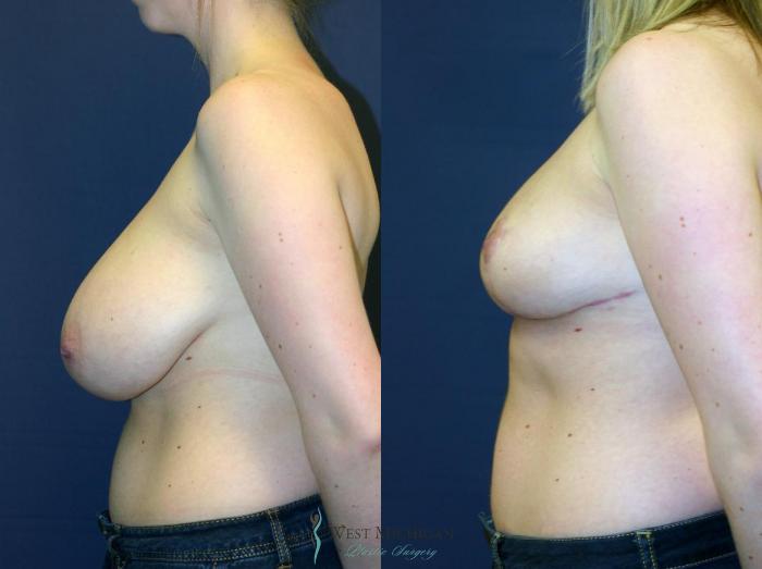 Before & After Breast Reduction Case 9119 View #2 View in Portage, Kalamazoo, Battle Creek, Michigan