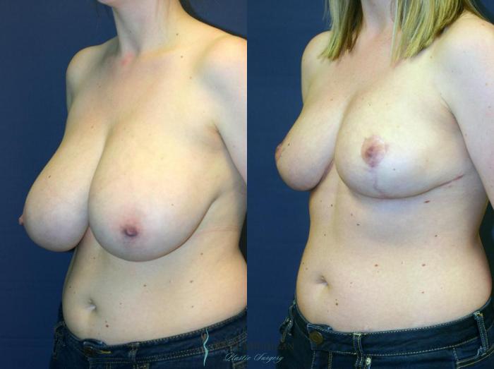 Before & After Breast Reduction Case 9119 View #3 View in Portage, Kalamazoo, Battle Creek, Michigan