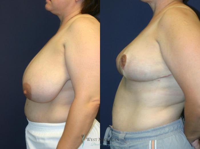 Before & After Breast Reduction Case 9120 View #2 View in Portage, Kalamazoo, Battle Creek, Michigan