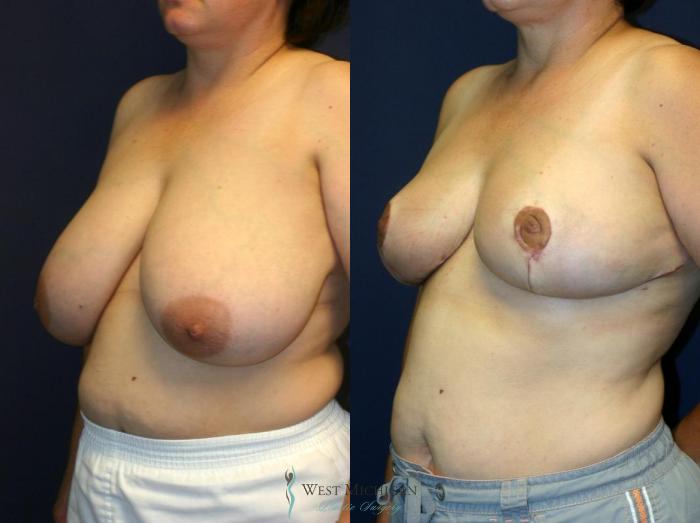 Before & After Breast Reduction Case 9120 View #3 View in Portage, Kalamazoo, Battle Creek, Michigan