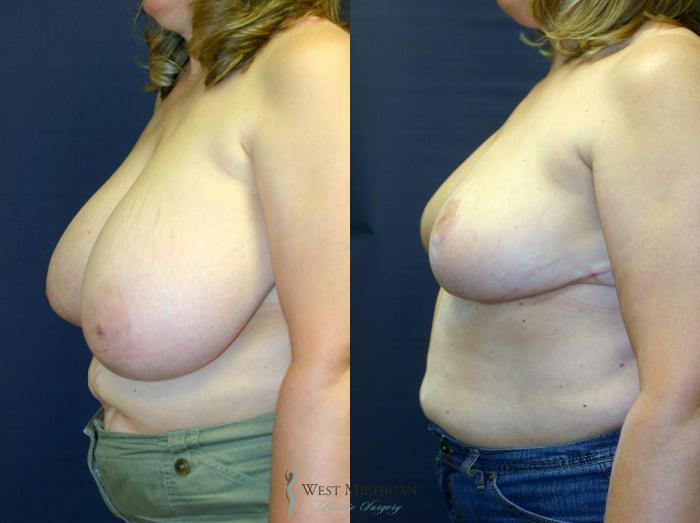 Before & After Breast Reduction Case 9121 View #2 View in Portage, Kalamazoo, Battle Creek, Michigan