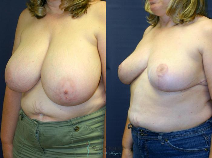 Before & After Breast Reduction Case 9121 View #3 View in Portage, Kalamazoo, Battle Creek, Michigan