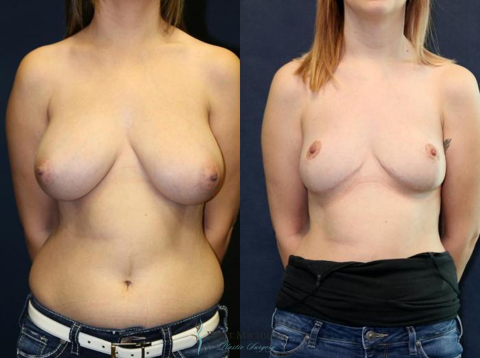 Before & After Breast Reduction Case 9122 View #1 View in Portage, Kalamazoo, Battle Creek, Michigan