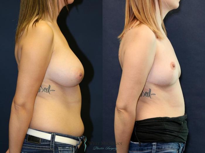 Before & After Breast Reduction Case 9122 View #2 View in Portage, Kalamazoo, Battle Creek, Michigan