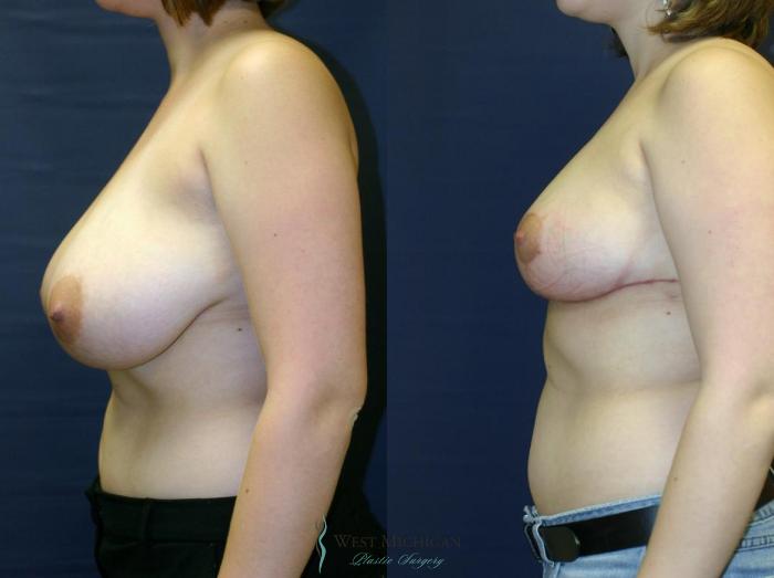 Before & After Breast Reduction Case 9123 View #2 View in Portage, Kalamazoo, Battle Creek, Michigan