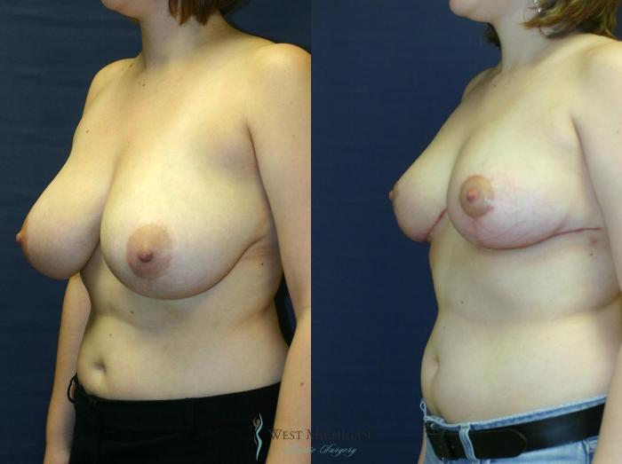 Before & After Breast Reduction Case 9123 View #3 View in Portage, Kalamazoo, Battle Creek, Michigan