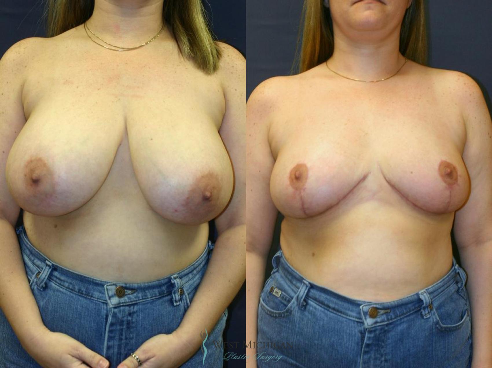 Before & After Breast Reduction Case 9124 View #1 View in Kalamazoo & Grand Rapids, Michigan
