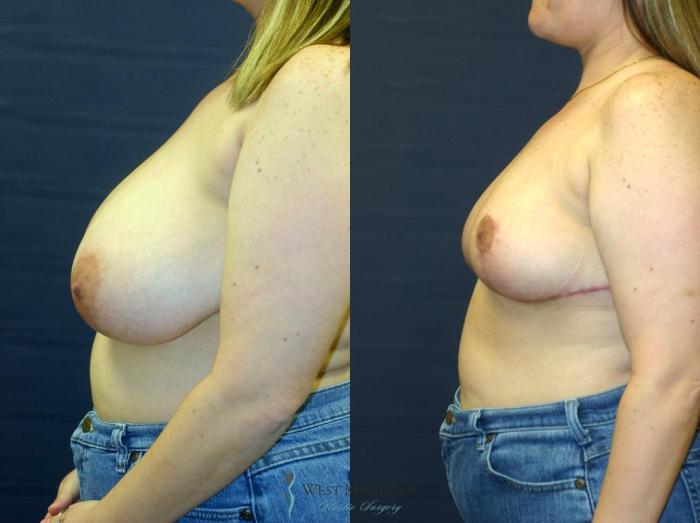 Before & After Breast Reduction Case 9124 View #2 View in Portage, Kalamazoo, Battle Creek, Michigan