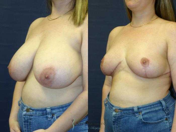 Before & After Breast Reduction Case 9124 View #3 View in Portage, Kalamazoo, Battle Creek, Michigan