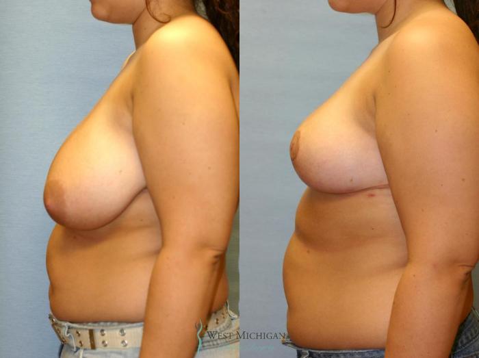 Before & After Breast Reduction Case 9125 View #2 View in Portage, Kalamazoo, Battle Creek, Michigan