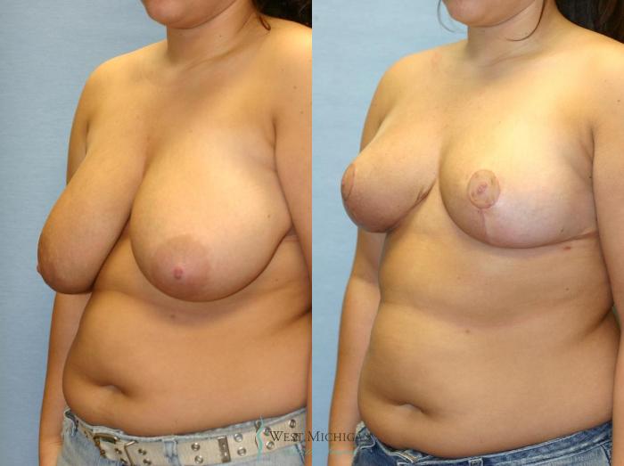 Before & After Breast Reduction Case 9125 View #3 View in Portage, Kalamazoo, Battle Creek, Michigan