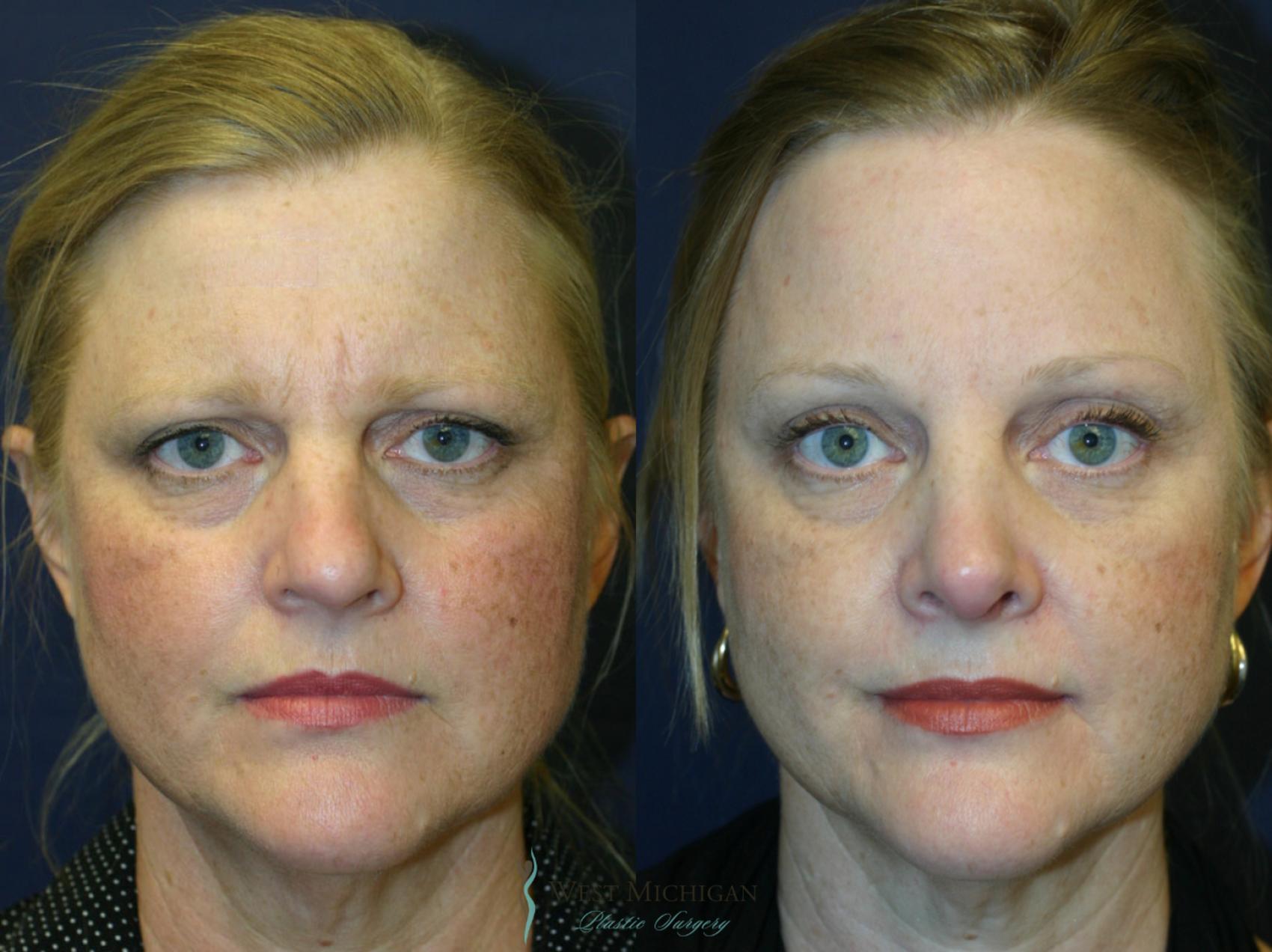 Before & After Brow Lift Case 8828 View #1 View in Portage, Kalamazoo, Battle Creek, Michigan