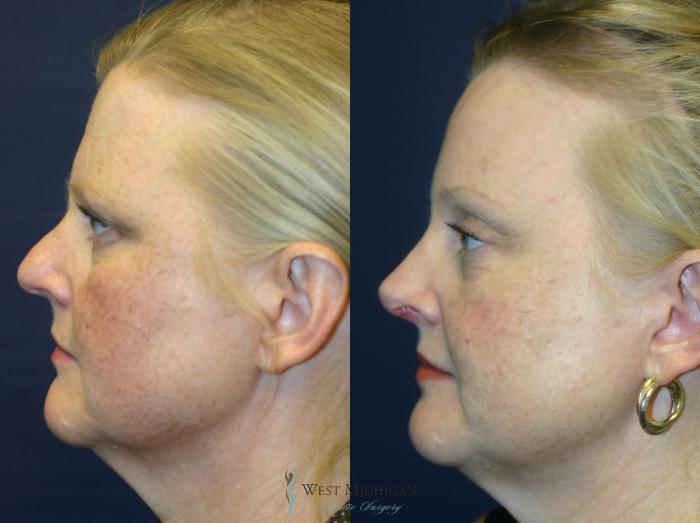 Before & After Brow Lift Case 8828 View #2 View in Portage, Kalamazoo, Battle Creek, Michigan