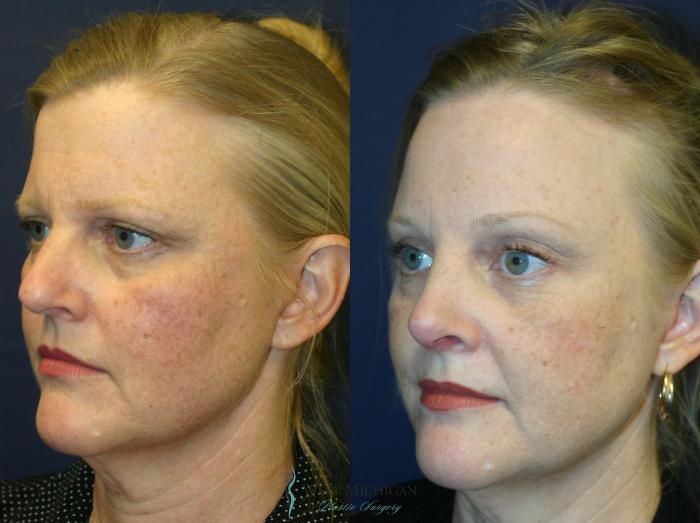 Before & After Brow Lift Case 8828 View #3 View in Portage, Kalamazoo, Battle Creek, Michigan