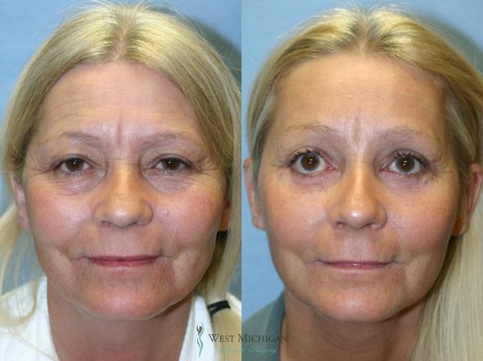 Before & After Brow Lift Case 8829 View #1 View in Portage, Kalamazoo, Battle Creek, Michigan