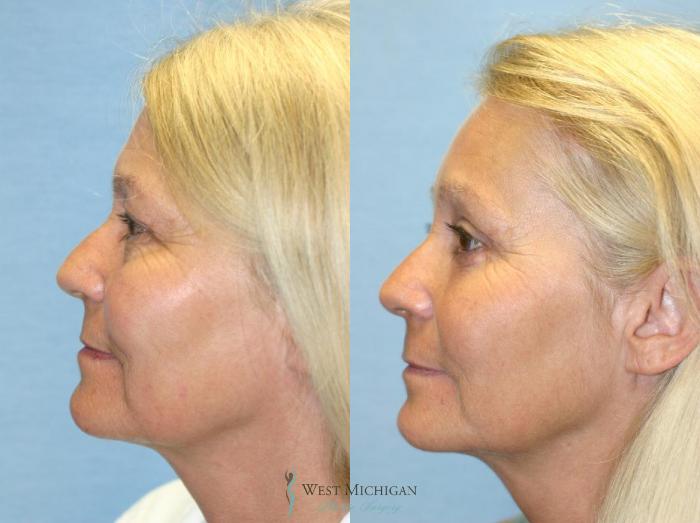 Before & After Brow Lift Case 8829 View #2 View in Portage, Kalamazoo, Battle Creek, Michigan