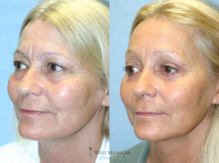 Before & After Brow Lift Case 8829 View #3 View in Portage, Kalamazoo, Battle Creek, Michigan