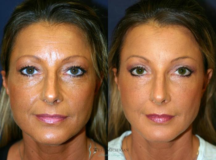 Before & After Brow Lift Case 8830 View #1 View in Portage, Kalamazoo, Battle Creek, Michigan