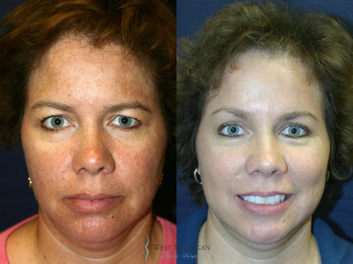 Before & After Brow Lift Case 8831 View #1 View in Portage, Kalamazoo, Battle Creek, Michigan