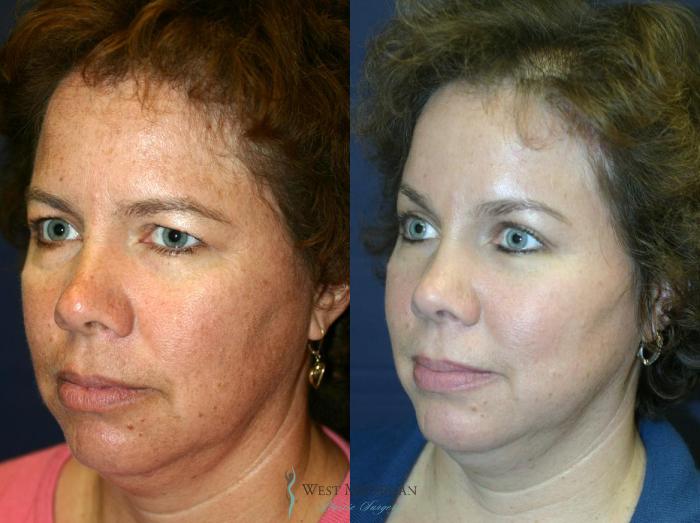 Before & After Brow Lift Case 8831 View #3 View in Portage, Kalamazoo, Battle Creek, Michigan