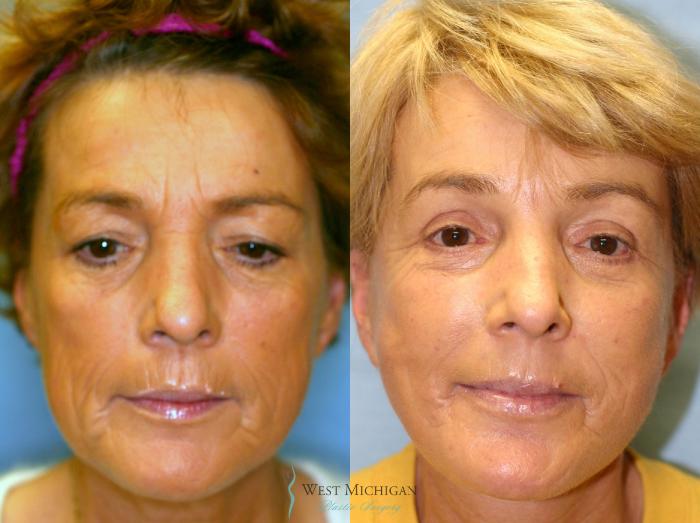Before & After Brow Lift Case 8833 View #1 View in Portage, Kalamazoo, Battle Creek, Michigan