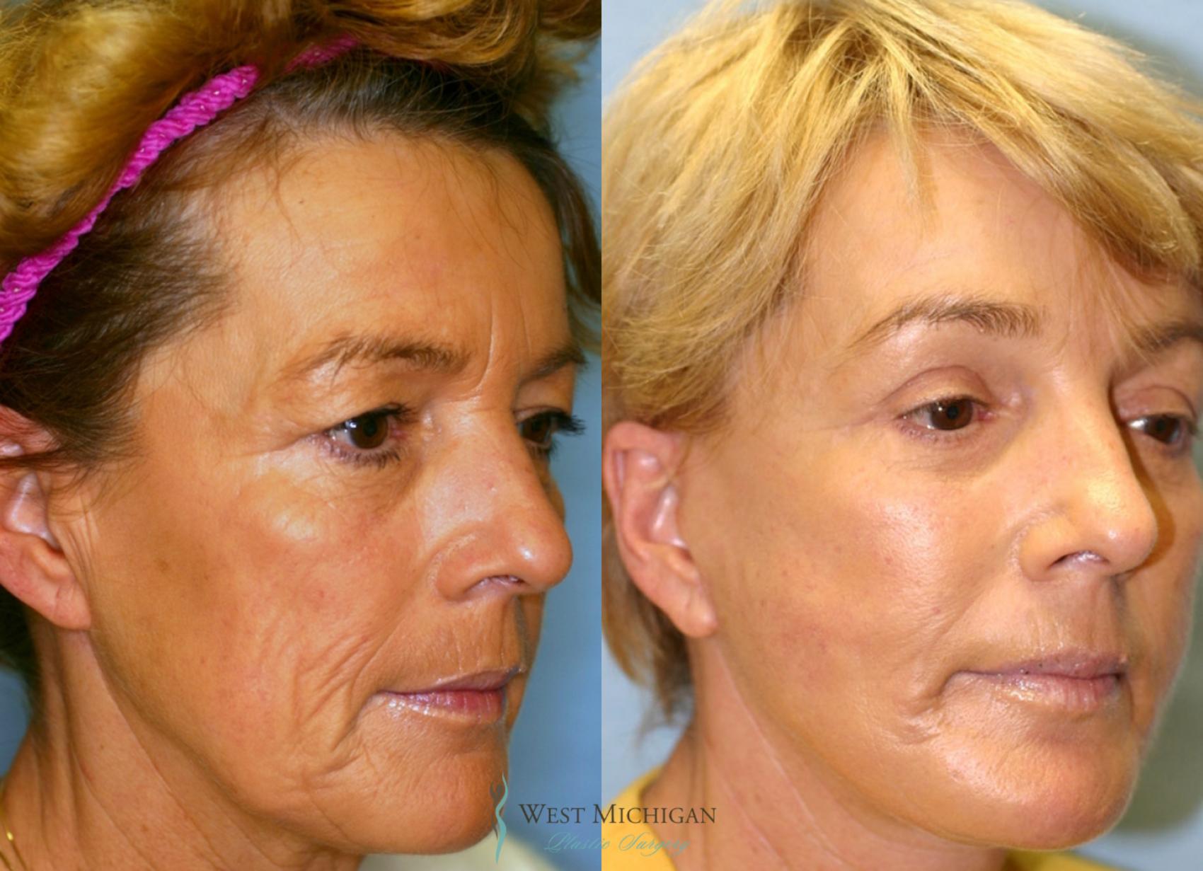 Before & After Brow Lift Case 8833 View #3 View in Kalamazoo & Grand Rapids, Michigan