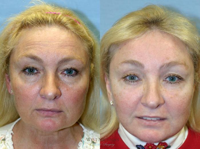 Before & After Brow Lift Case 8834 View #1 View in Portage, Kalamazoo, Battle Creek, Michigan