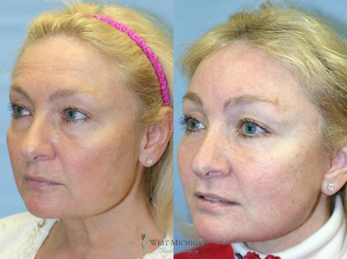 Before & After Brow Lift Case 8834 View #3 View in Portage, Kalamazoo, Battle Creek, Michigan