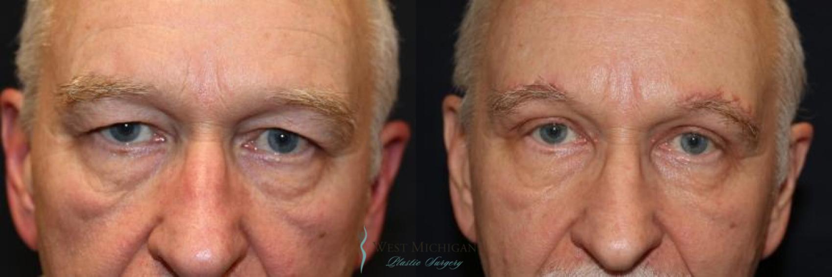 Before & After Brow Lift Case 8835 View #1 View in Portage, Kalamazoo, Battle Creek, Michigan