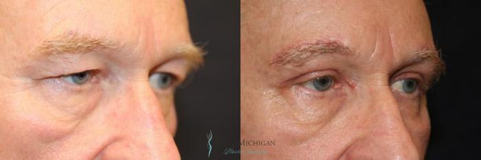 Before & After Brow Lift Case 8835 View #2 View in Portage, Kalamazoo, Battle Creek, Michigan