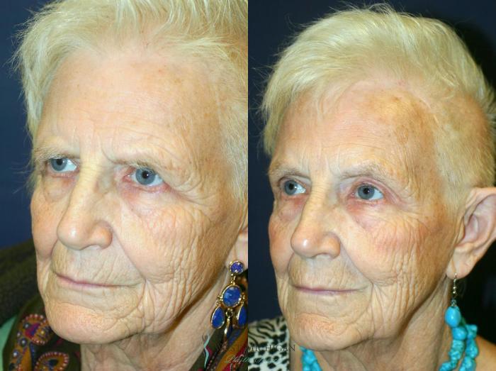 Before & After Brow Lift Case 8837 View #3 View in Portage, Kalamazoo, Battle Creek, Michigan