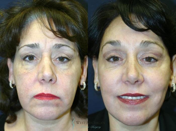Before & After Brow Lift Case 8838 View #1 View in Portage, Kalamazoo, Battle Creek, Michigan