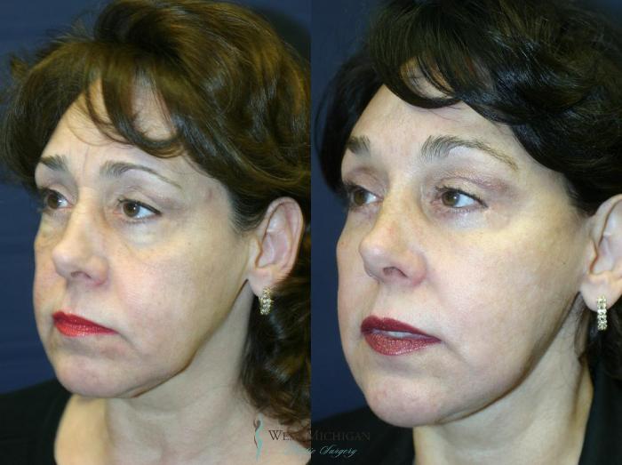 Before & After Brow Lift Case 8838 View #3 View in Portage, Kalamazoo, Battle Creek, Michigan