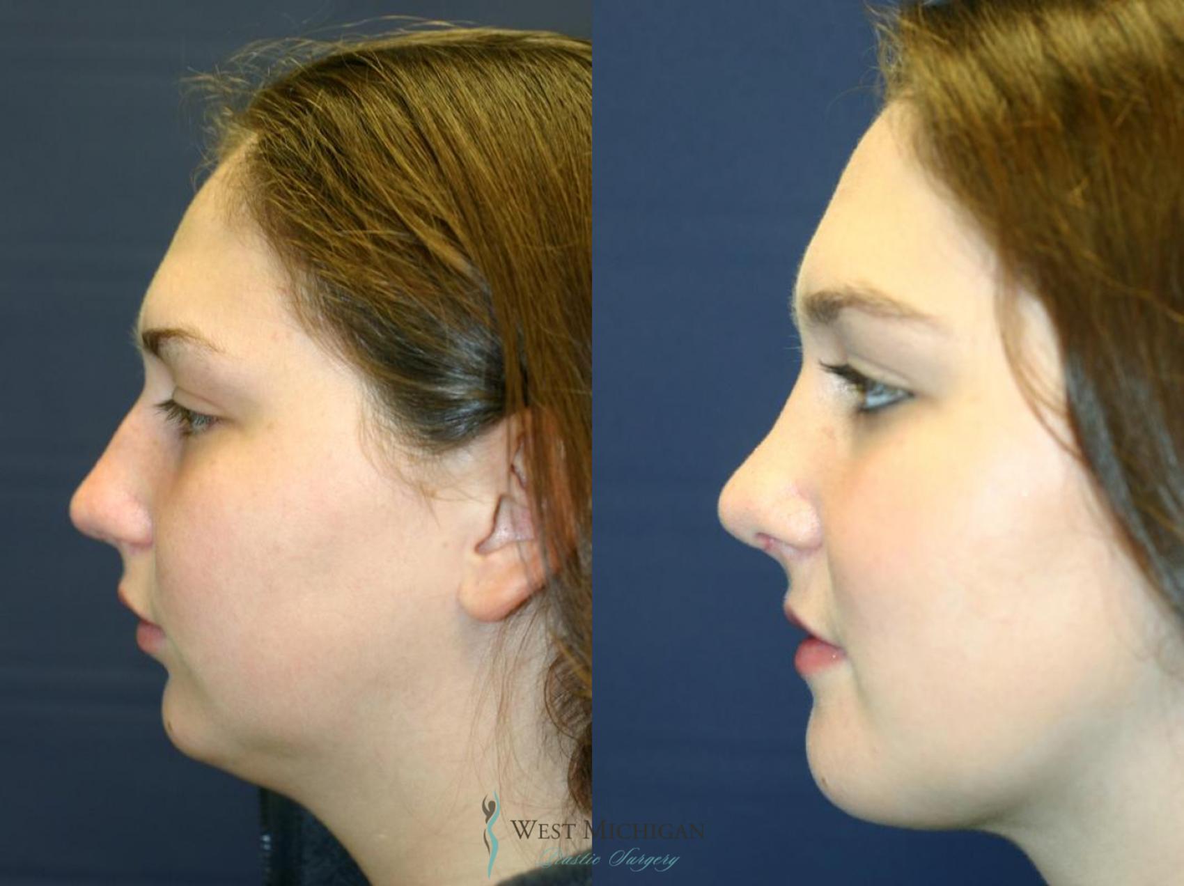 Before & After Chin Augmentation Case 8737 View #1 View in Portage, Kalamazoo, Battle Creek, Michigan