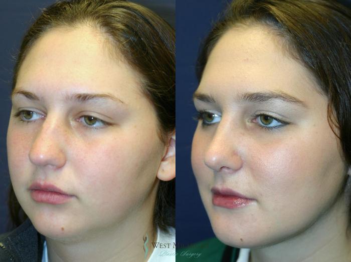 Before & After Chin Augmentation Case 8737 View #2 View in Portage, Kalamazoo, Battle Creek, Michigan