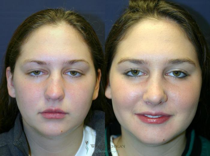 Before & After Chin Augmentation Case 8737 View #3 View in Portage, Kalamazoo, Battle Creek, Michigan