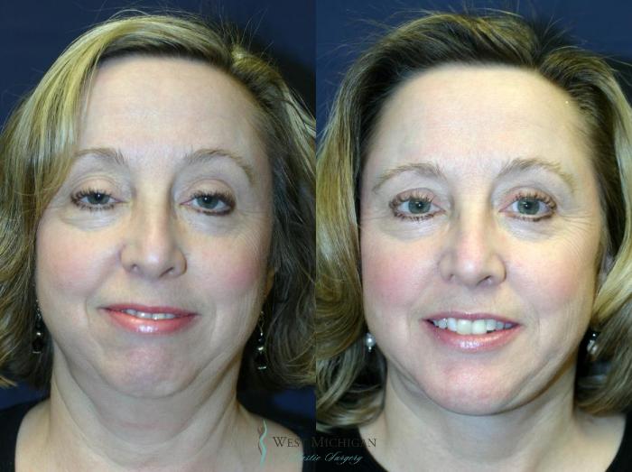 Before & After Chin Augmentation Case 8839 View #1 View in Portage, Kalamazoo, Battle Creek, Michigan