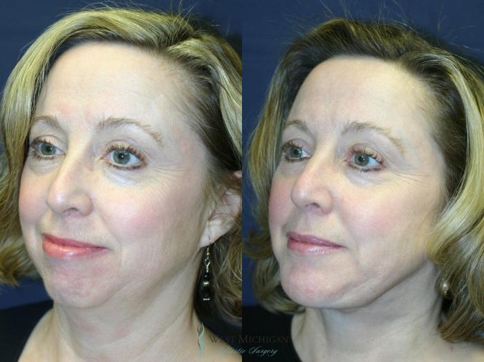 Before & After Chin Augmentation Case 8839 View #3 View in Portage, Kalamazoo, Battle Creek, Michigan