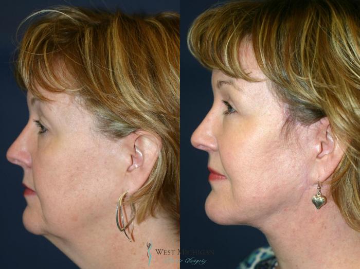Before & After Chin Augmentation Case 8840 View #2 View in Portage, Kalamazoo, Battle Creek, Michigan