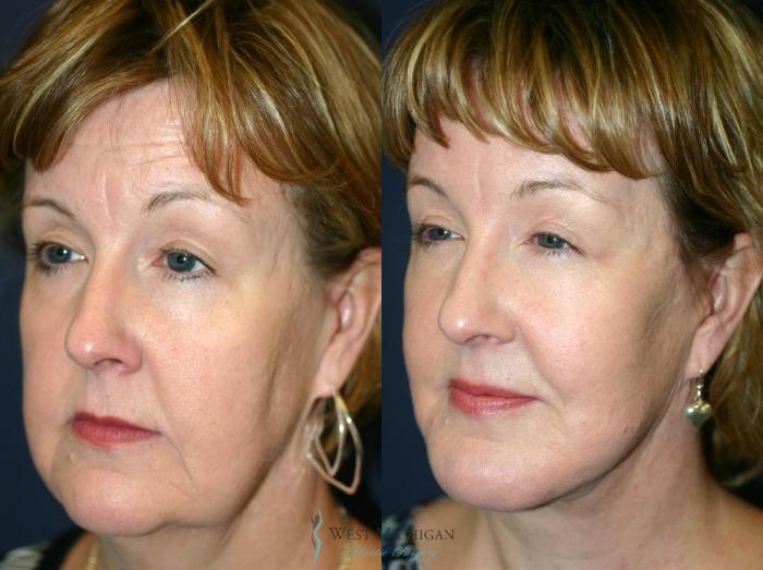 Before & After Chin Augmentation Case 8840 View #3 View in Portage, Kalamazoo, Battle Creek, Michigan