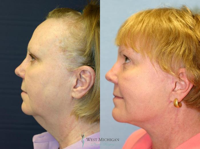 Before & After Chin Augmentation Case 8841 View #2 View in Portage, Kalamazoo, Battle Creek, Michigan