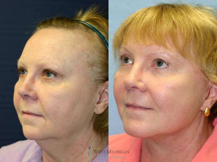 Before & After Chin Augmentation Case 8841 View #3 View in Portage, Kalamazoo, Battle Creek, Michigan