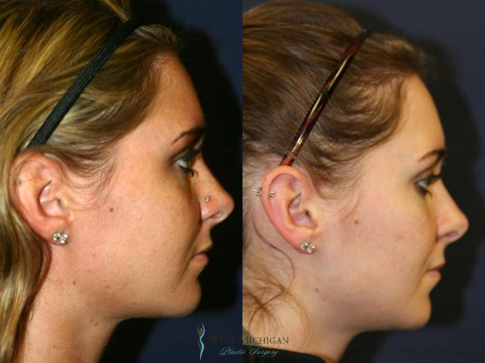 Before & After Ear Surgery Case 8879 View #2 View in Kalamazoo & Grand Rapids, Michigan