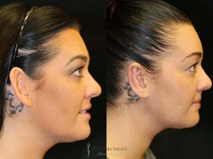 Before & After Ear Surgery Case 8880 View #2 View in Kalamazoo & Grand Rapids, Michigan