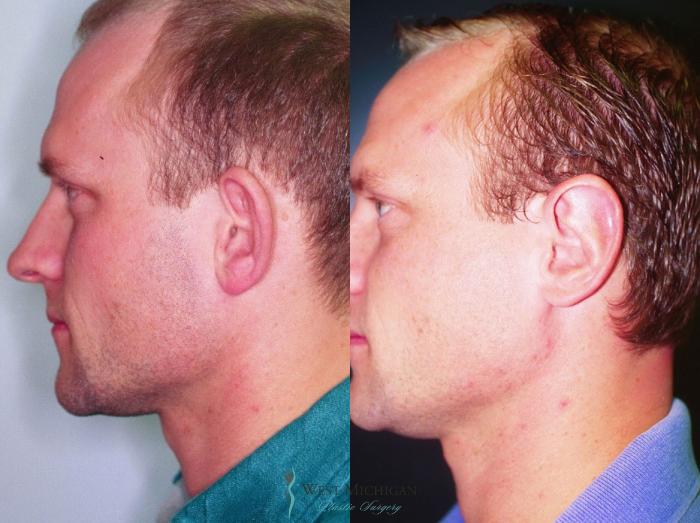 Before & After Ear Surgery Case 8881 View #2 View in Kalamazoo & Grand Rapids, Michigan