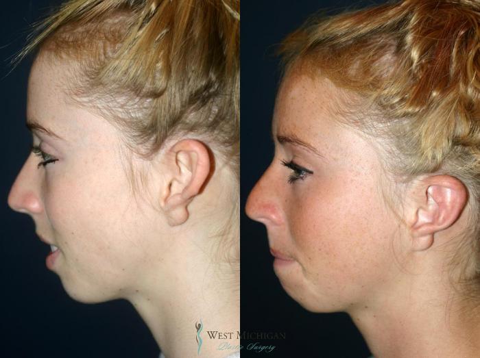 Before & After Ear Surgery Case 8882 View #2 View in Kalamazoo & Grand Rapids, Michigan