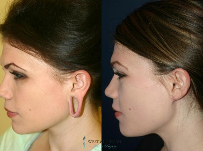 Before & After Ear Surgery Case 8884 View #3 View in Kalamazoo & Grand Rapids, Michigan