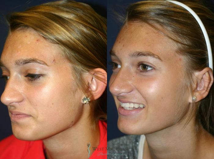 Before & After Ear Surgery Case 8885 View #2 View in Kalamazoo & Grand Rapids, Michigan
