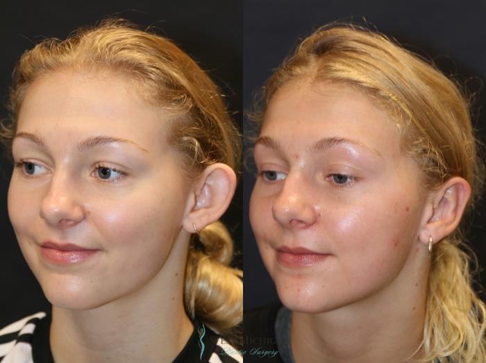 Before & After Ear Surgery Case 9329 Left Oblique View in Portage, Kalamazoo, Battle Creek, Michigan